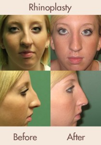 Ear & Earlobe Surgery  Visage Facial Plastic Surgery